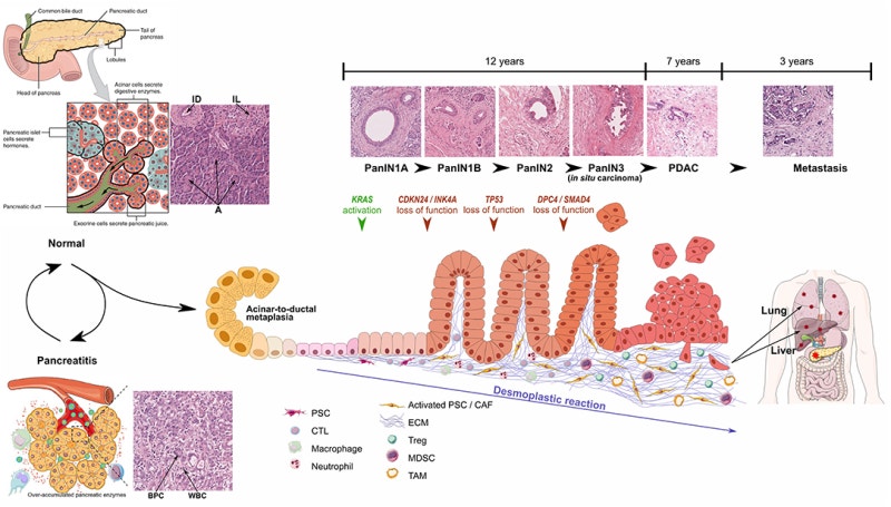 췌장암의 병인론 (etiology of pancreatic cancer)